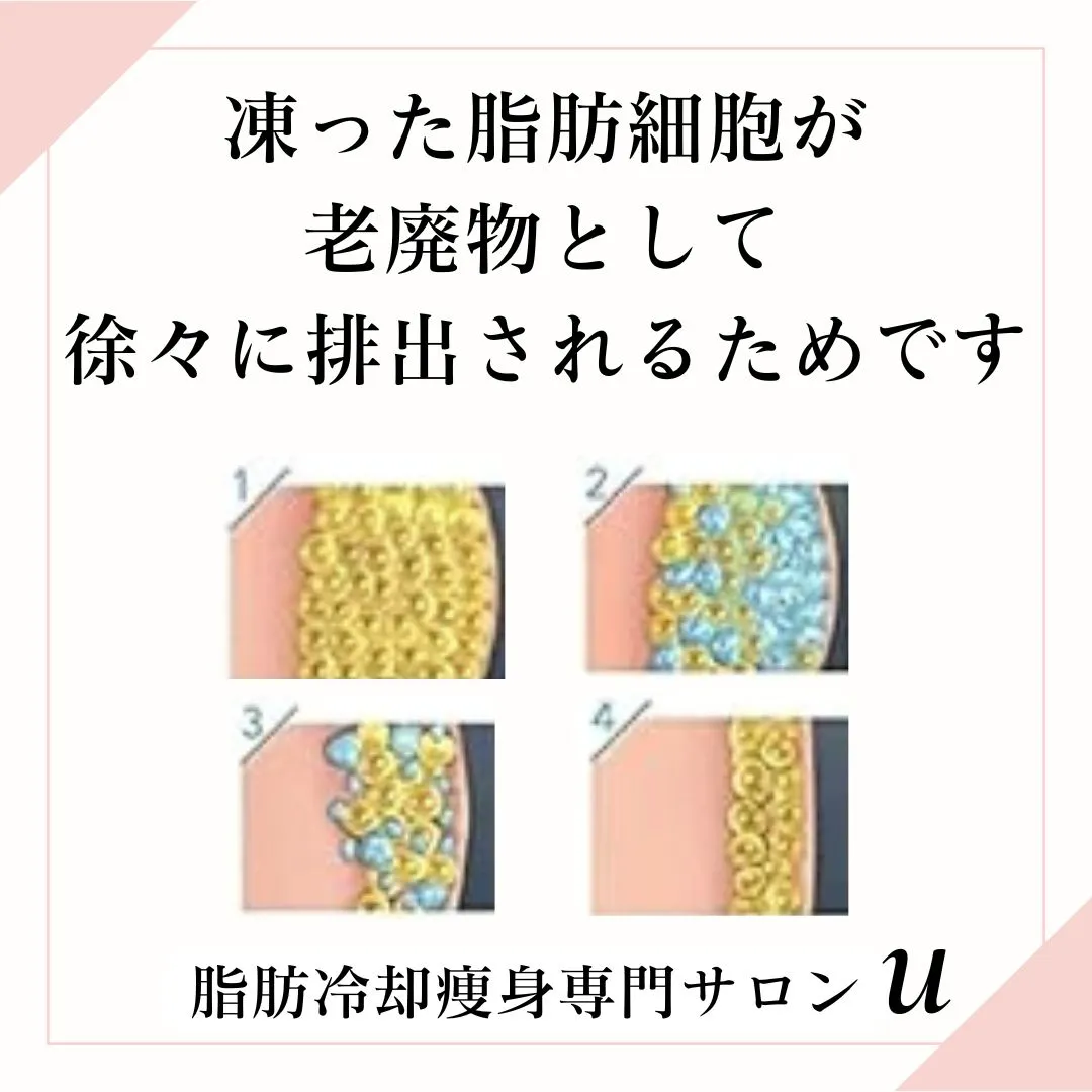 脂肪冷却は、脂肪細胞を冷却し、その細胞を凍らせて体外へ排出す...